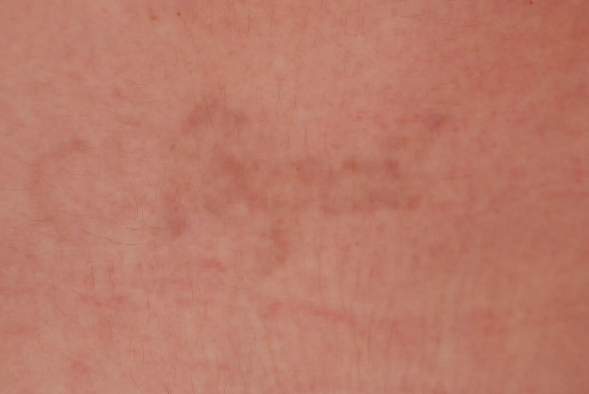 Script Name — tattoo removal result after 5 sessions