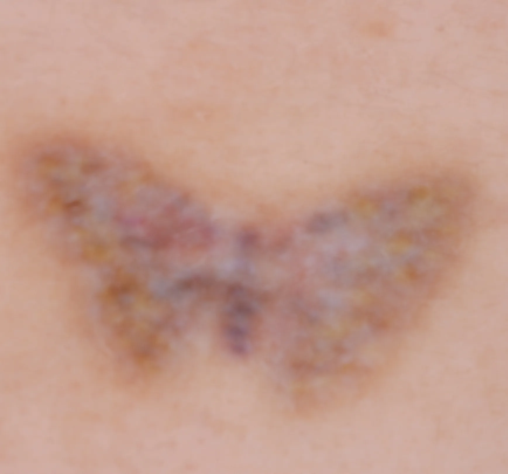 Colourful Butterfly — tattoo removal result after 6 sessions
