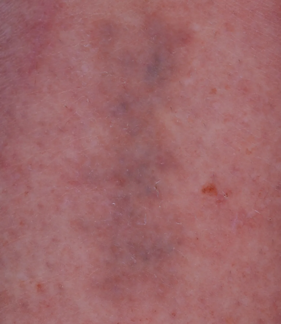 Chinese Characters — tattoo removal result after 6 sessions