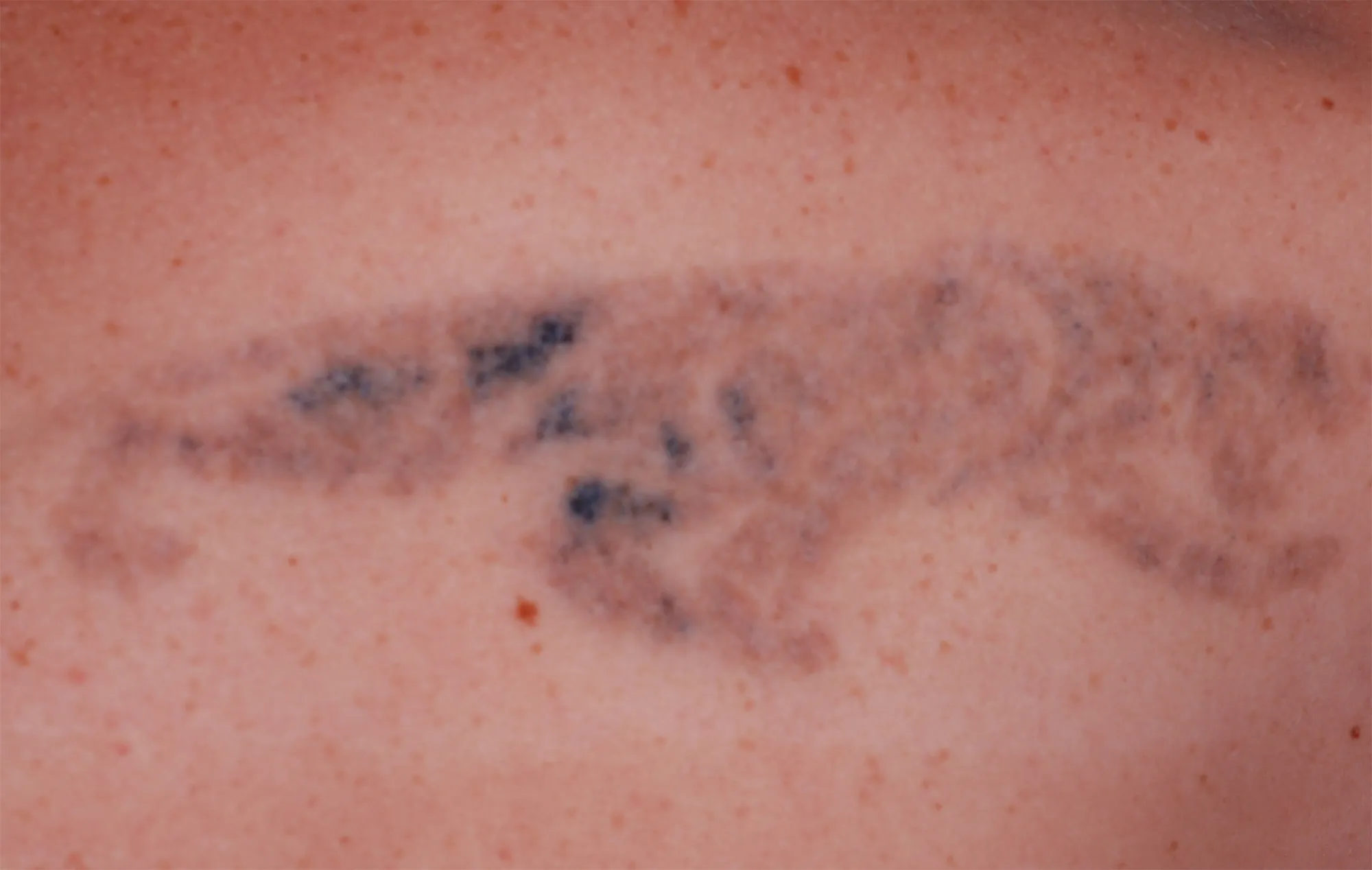 Panther Silhouette — tattoo removal result after 5 sessions