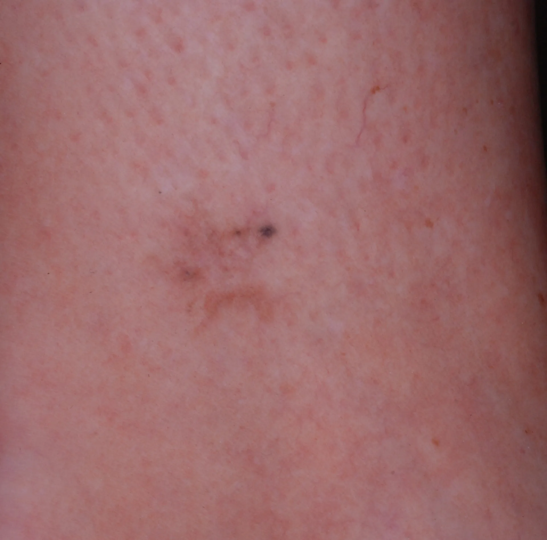 Small Star — tattoo removal result after 1 sessions