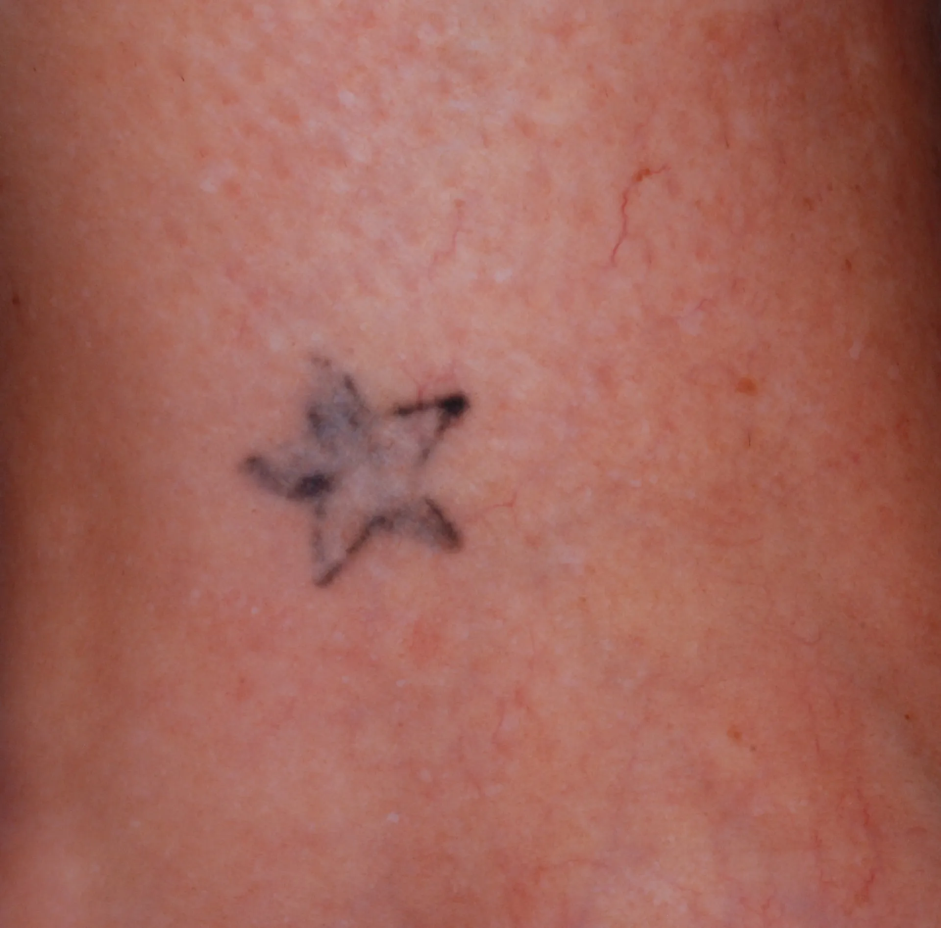 Small Star — tattoo before laser removal treatment
