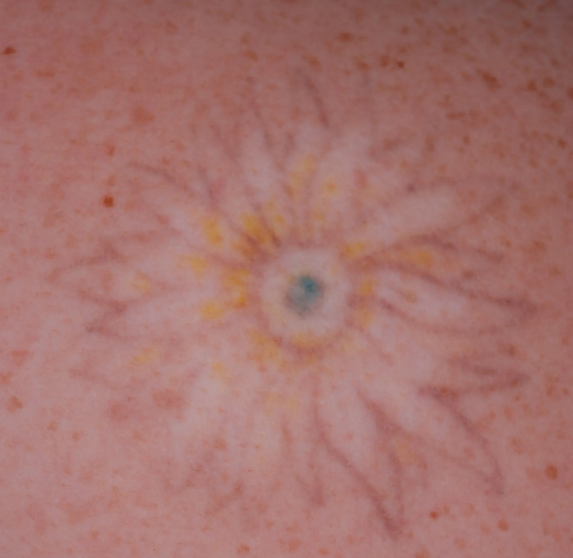 Sunflower — tattoo removal result after 6 sessions