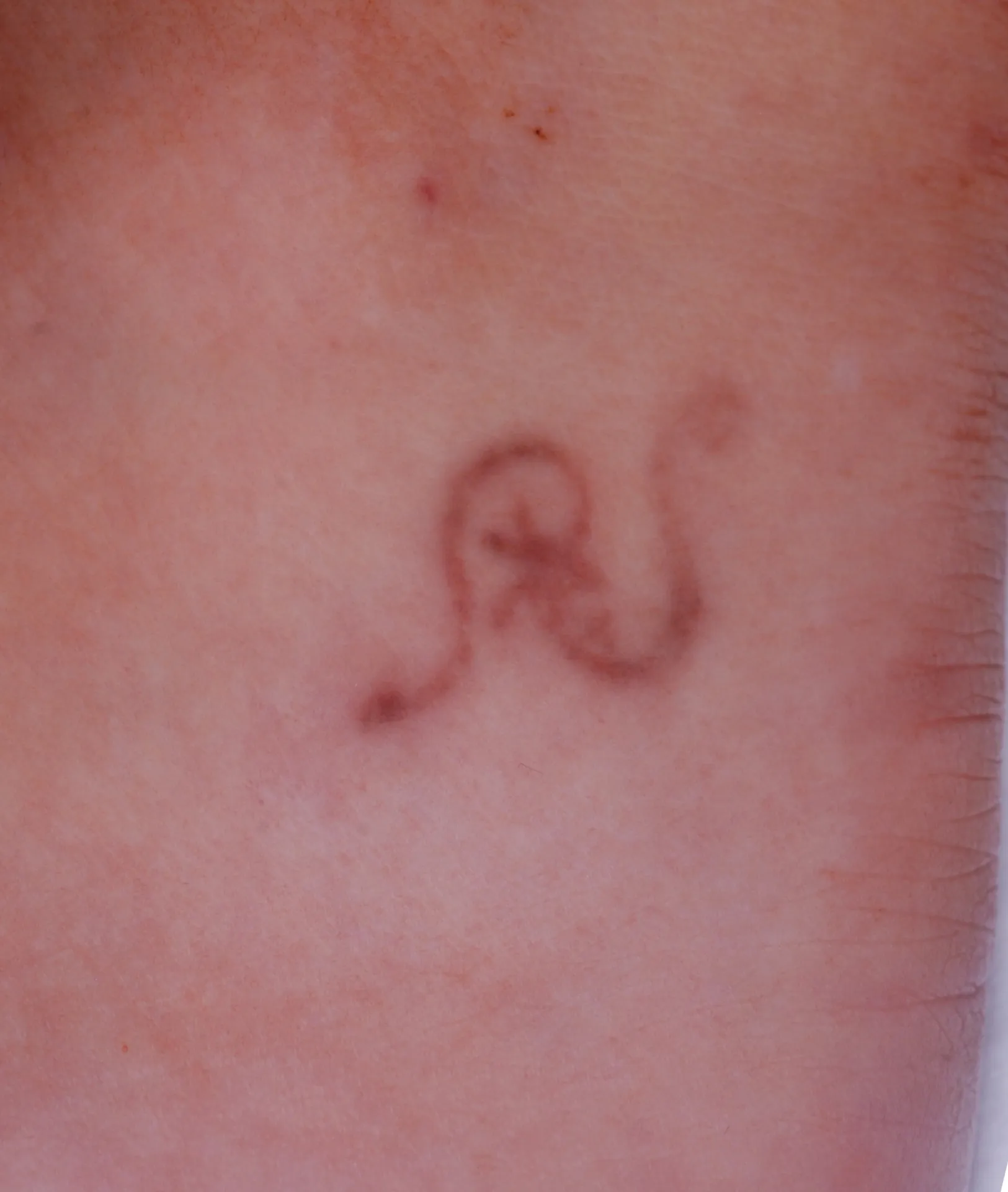 Decorative Symbol — tattoo removal result after 6 sessions