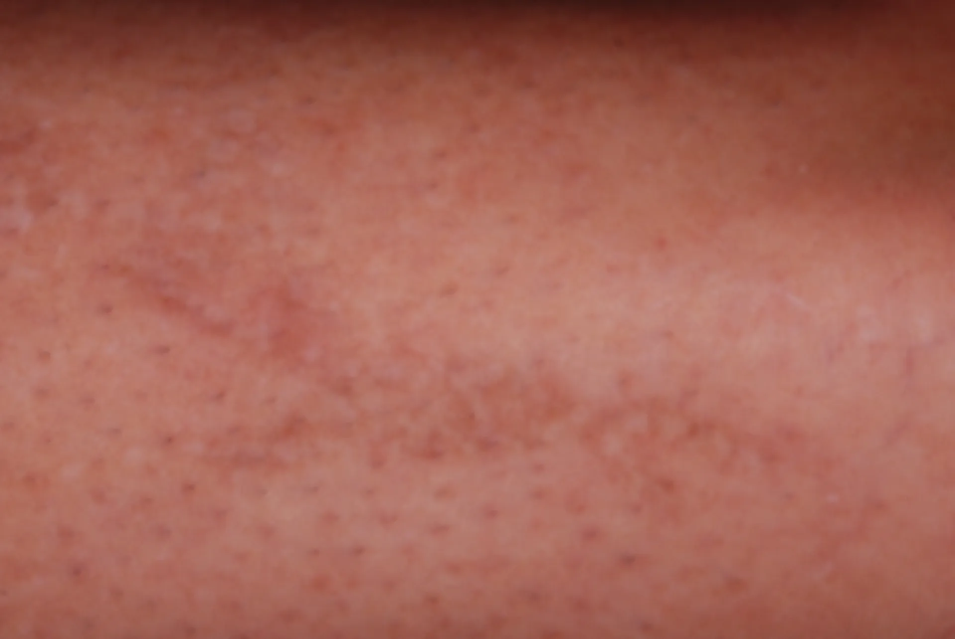 Black Tribal — tattoo removal result after 3 sessions