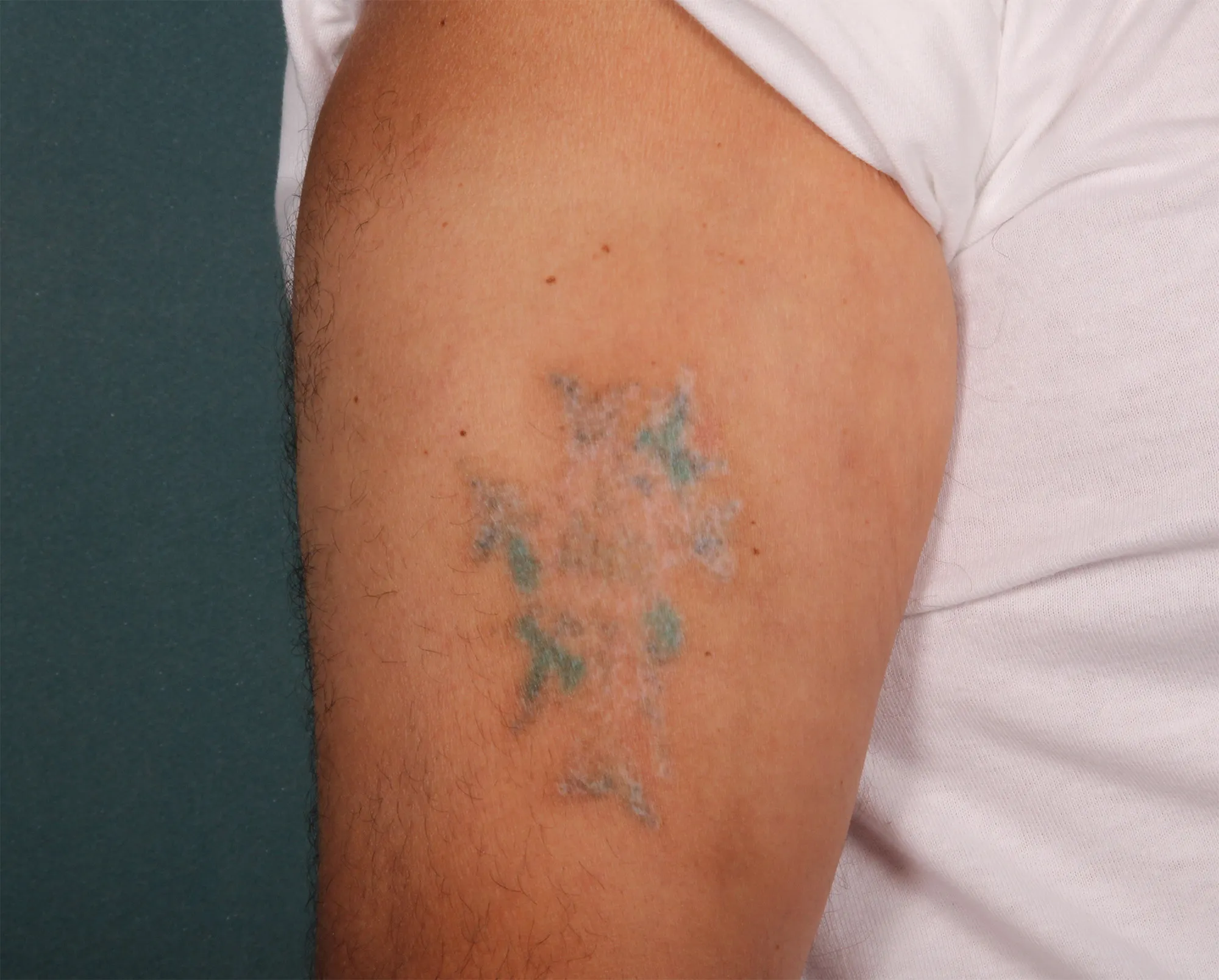 Cross with Heart — tattoo removal result after 5 sessions