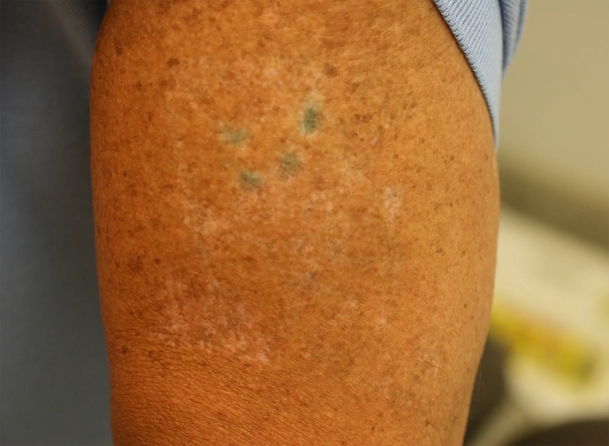 Amateur Figure — tattoo removal result after 6 sessions