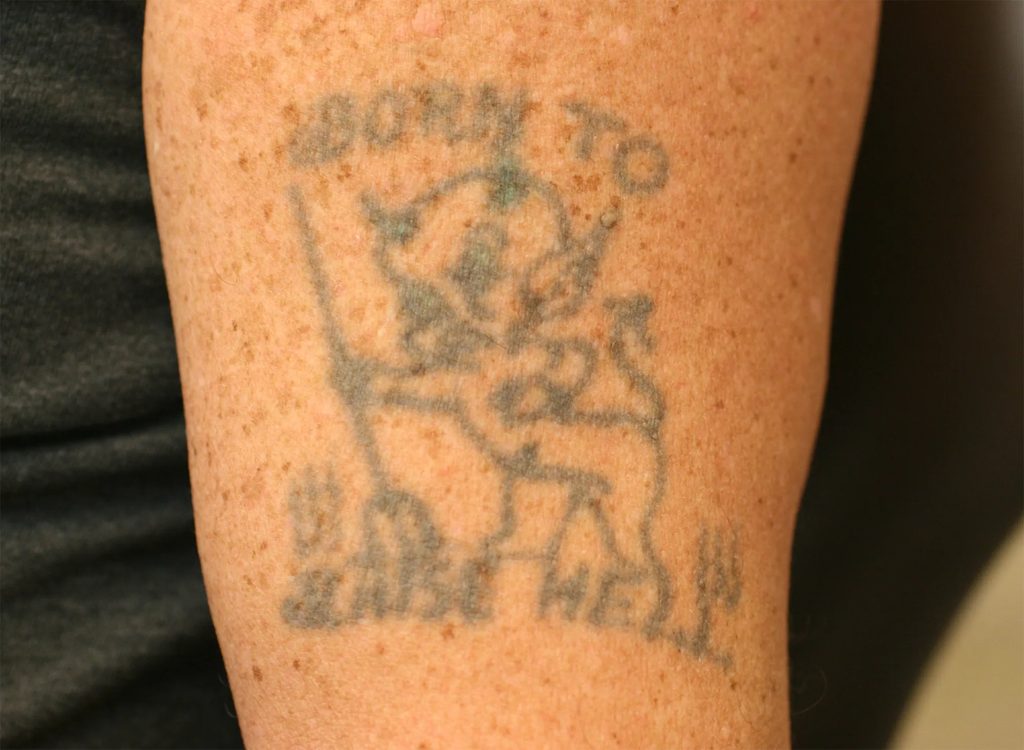 Amateur Figure — tattoo before laser removal treatment