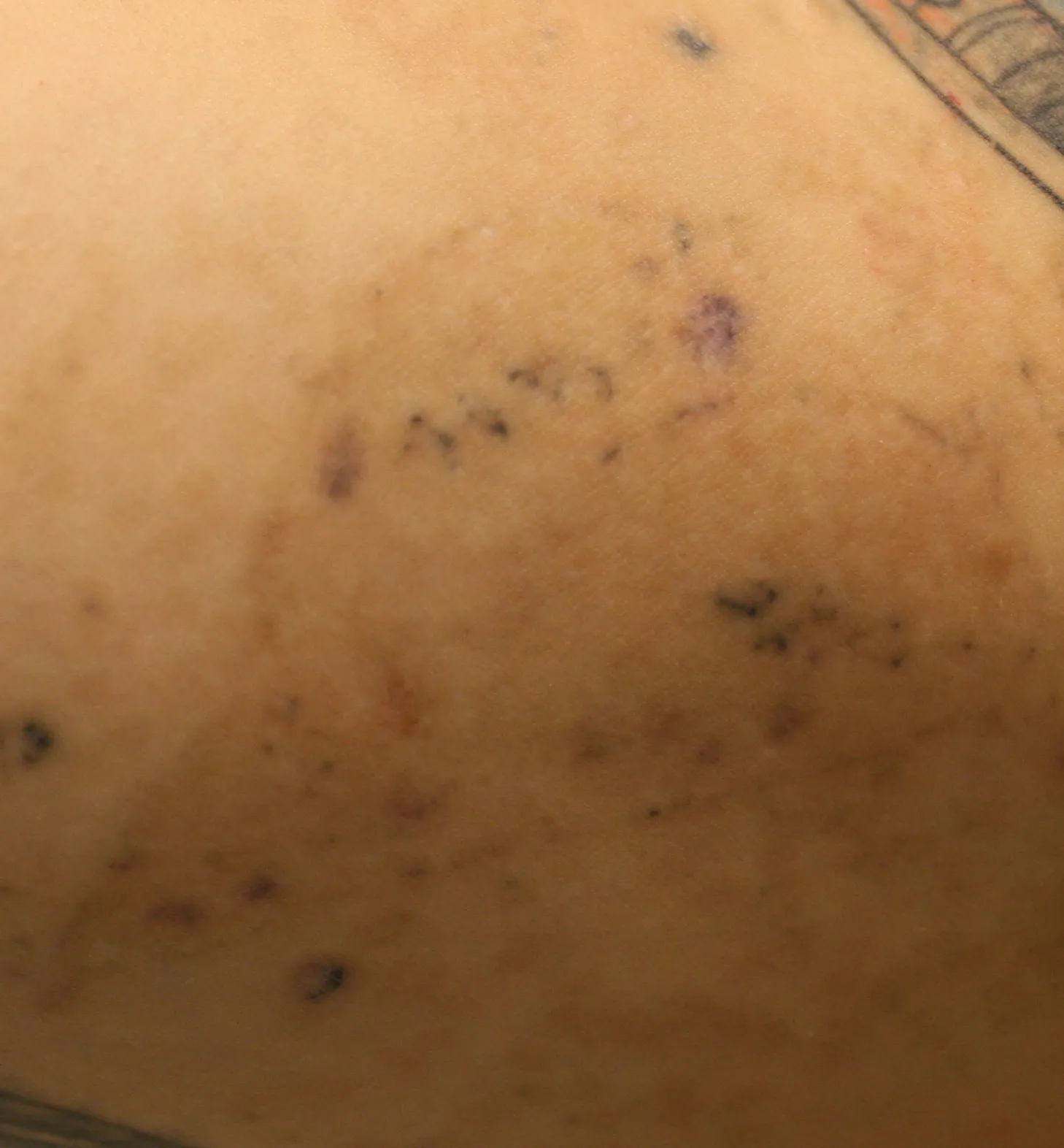 Coloured Footprints — tattoo removal result after 2 sessions