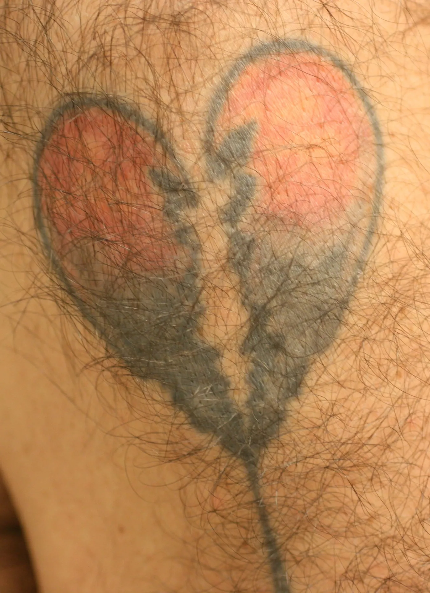 Heart with Red — tattoo before laser removal treatment