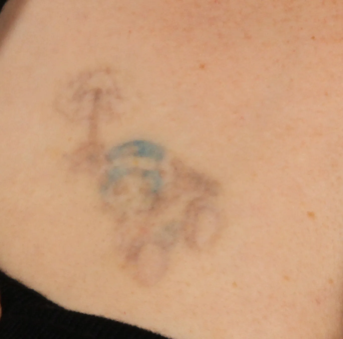 Cartoon Character — tattoo removal result after 8 sessions