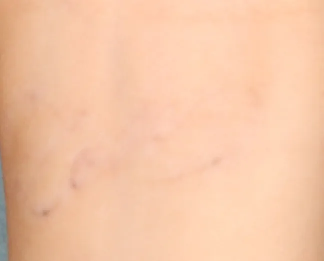 Script 'Love' — tattoo removal result after 6 sessions