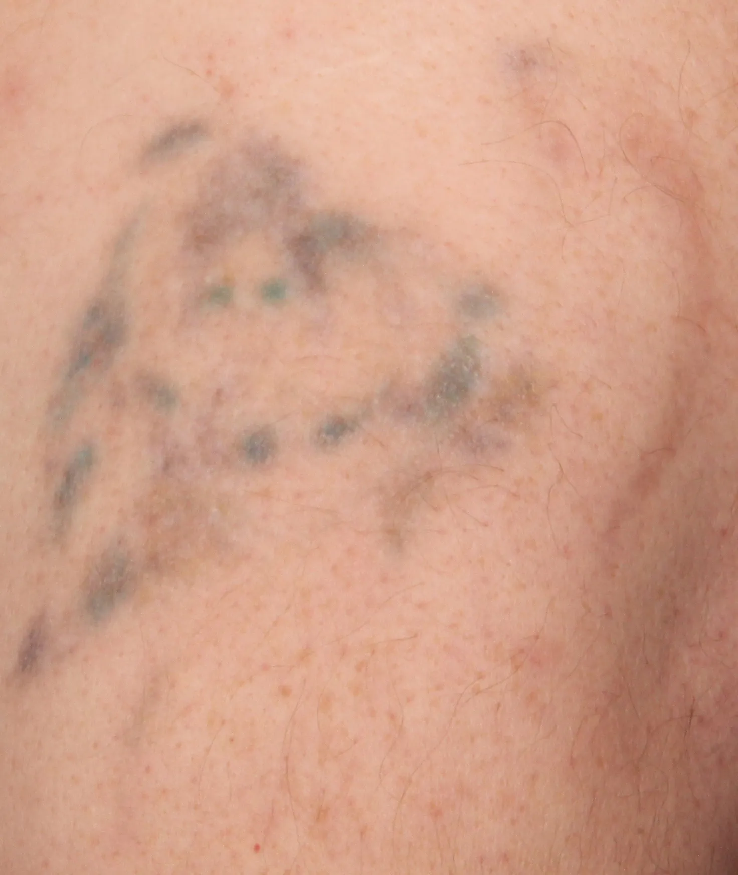 Coloured Reaper — tattoo removal result after 6 sessions