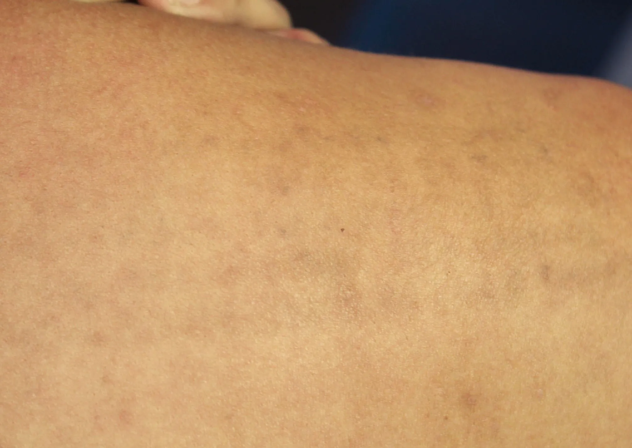 Text Quote — tattoo removal result after 5 sessions