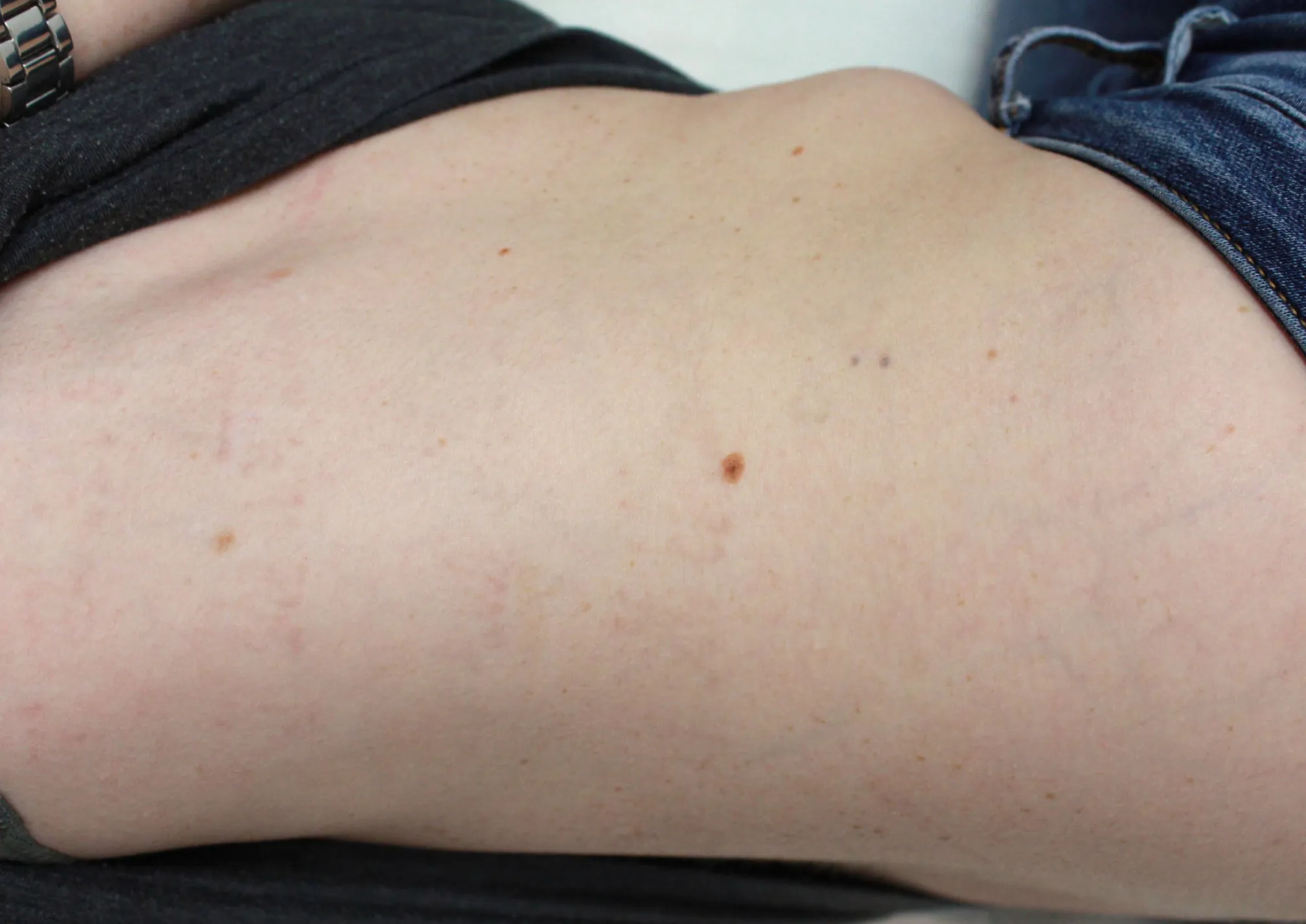 Cursive Script — tattoo removal result after 6 sessions