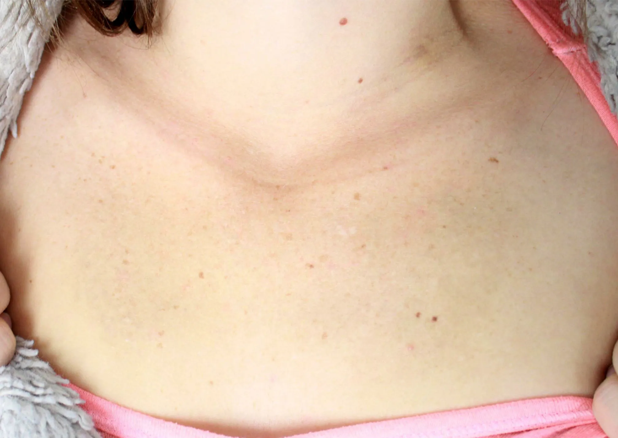 Memorial Wings — tattoo removal result after 6 sessions