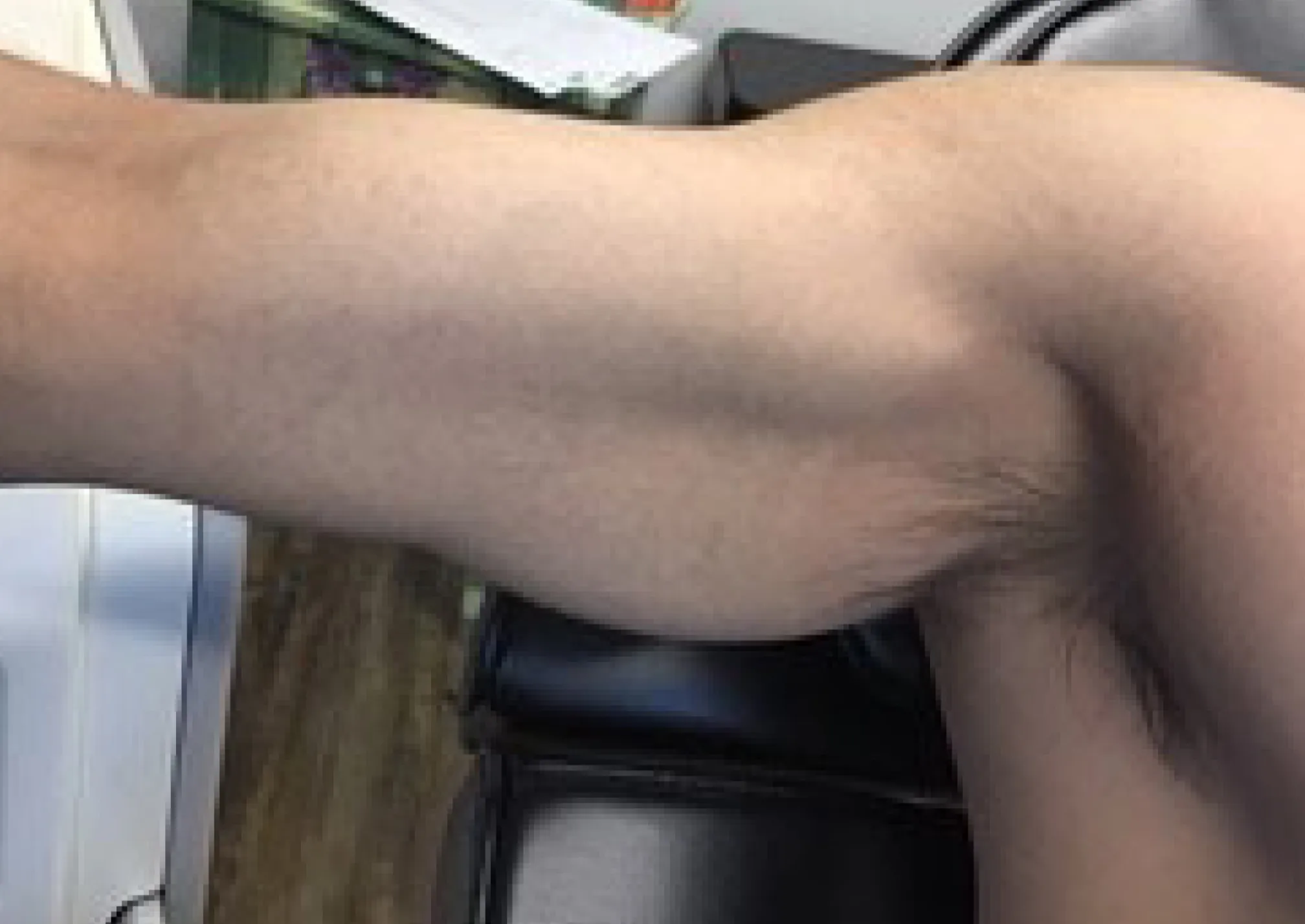 Arm Sleeve — tattoo removal result after 3 sessions