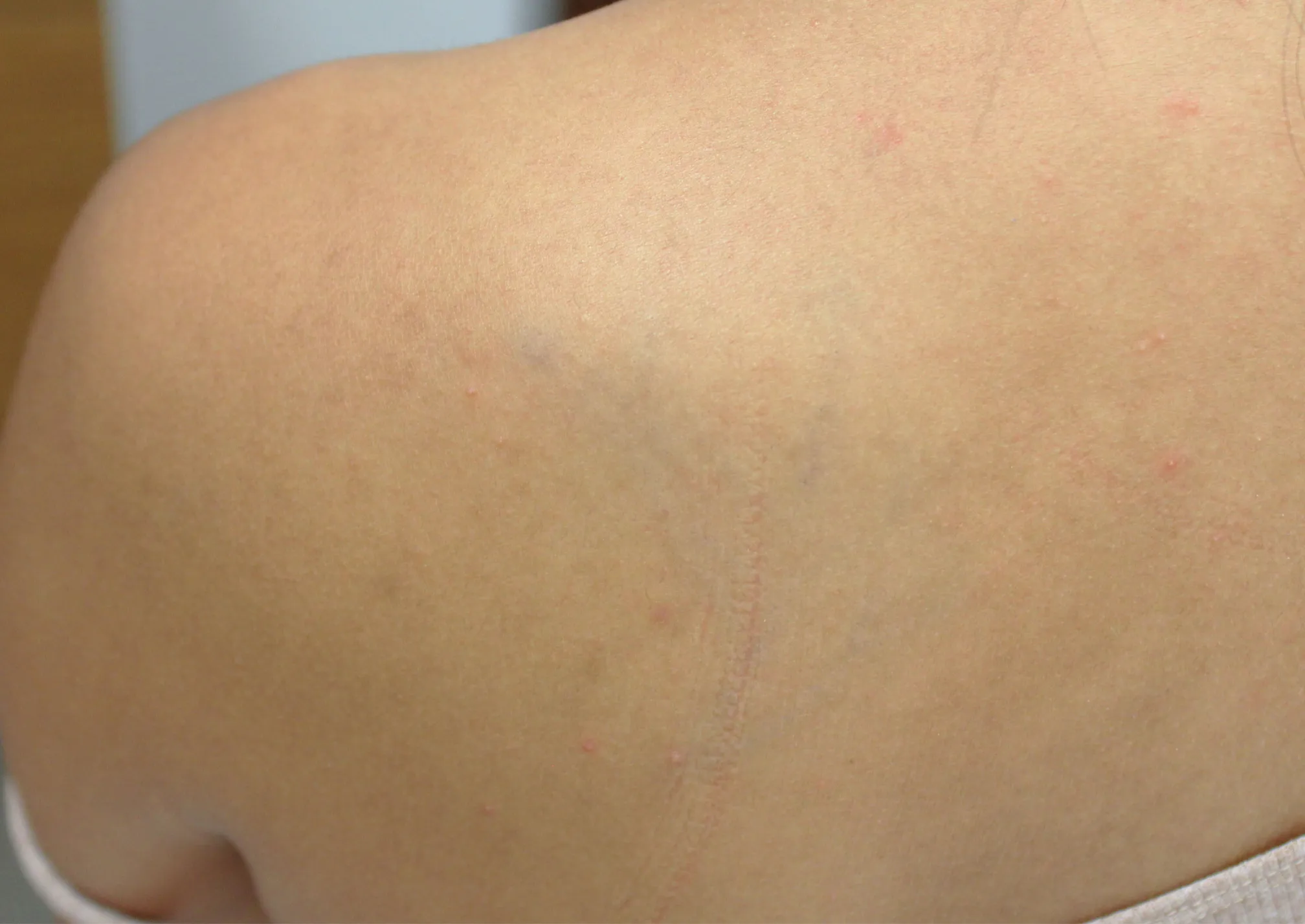 Tribal Design — tattoo removal result after 9 sessions